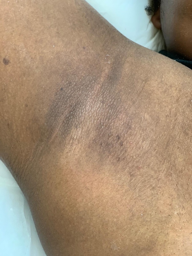 After underarms laser at Natura