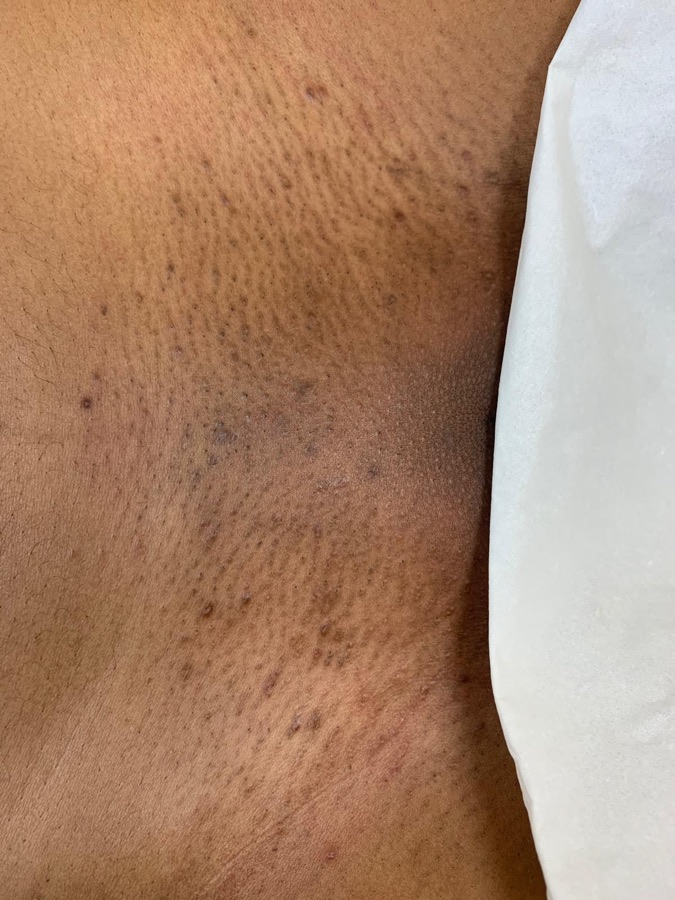 After underarms laser at Natura