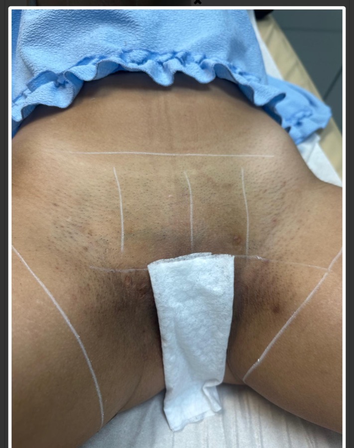After underarms laser at Natura