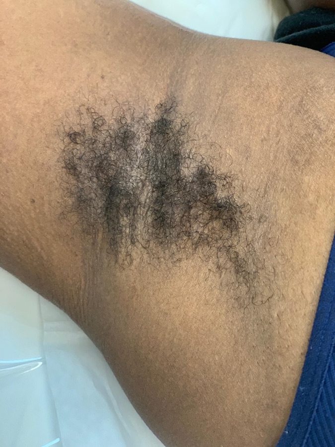 Before underarms laser at Natura