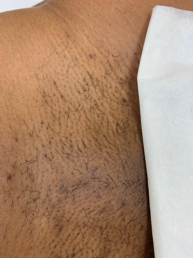 Before underarms laser at Natura