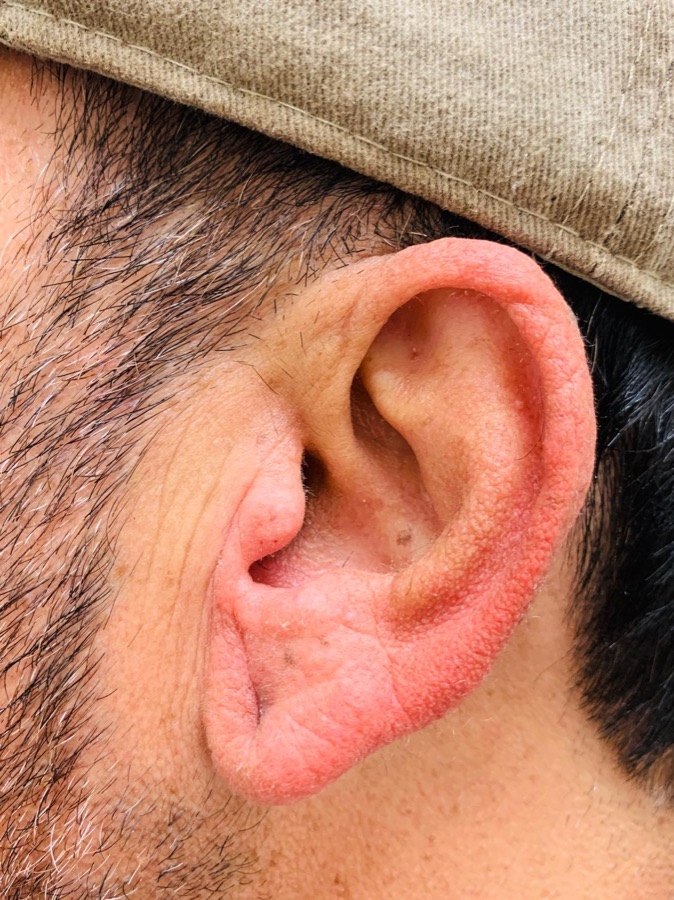 After ear & nose wax at Natura