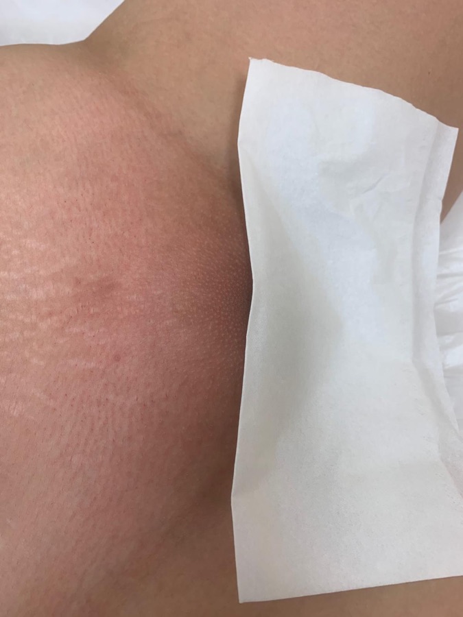 After underarms wax at Natura