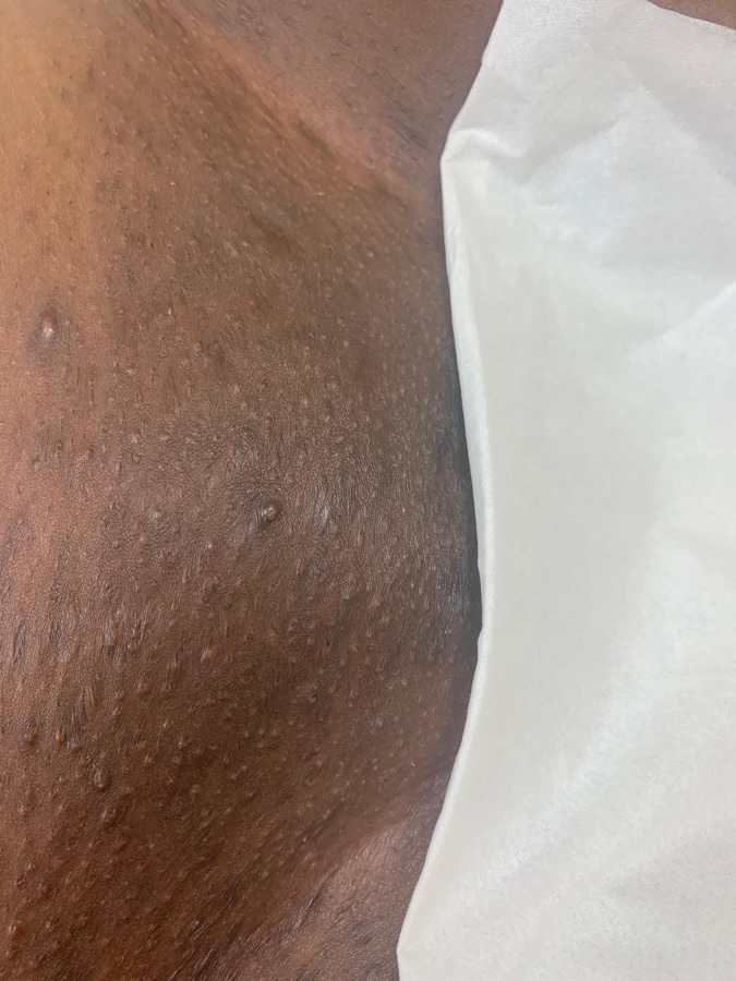 After bikini wax at Natura