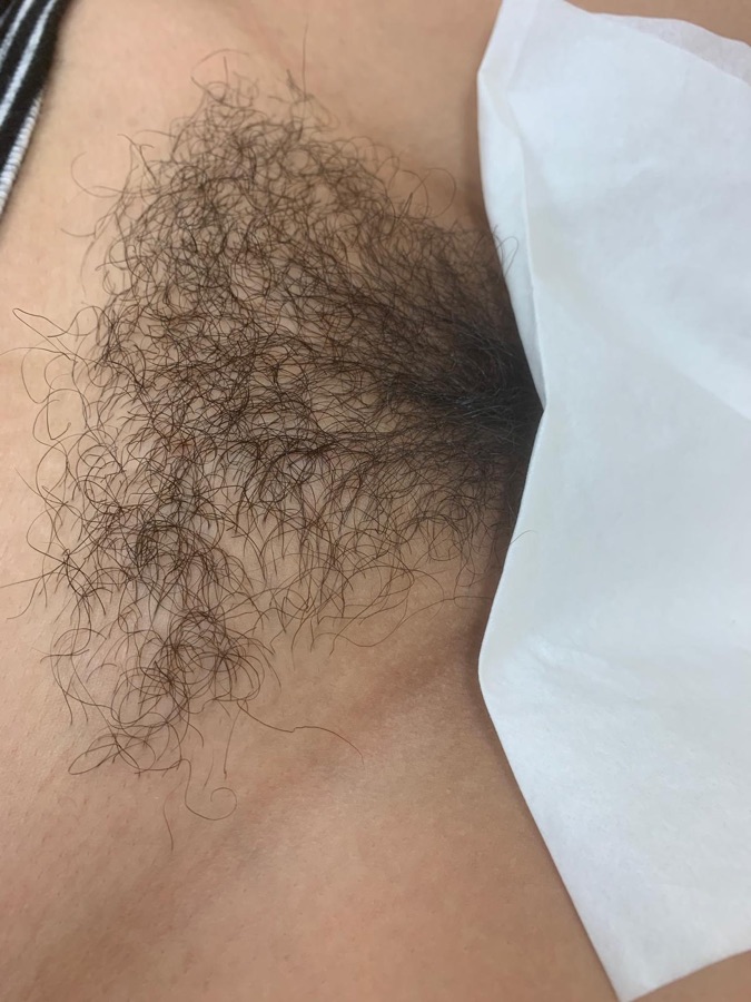 Before underarms wax at Natura